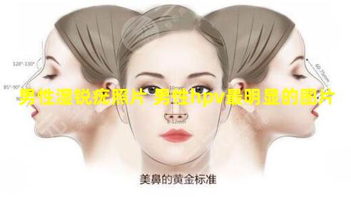 男性湿锐疣照片 男性hpv最明显的图片